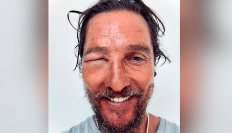 Matthew McConaughey Shares Photo Of Brutal Bee Sting In Eye